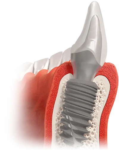 Coupe transversale d'une mâchoire avec un implant dentaire et une couronne.