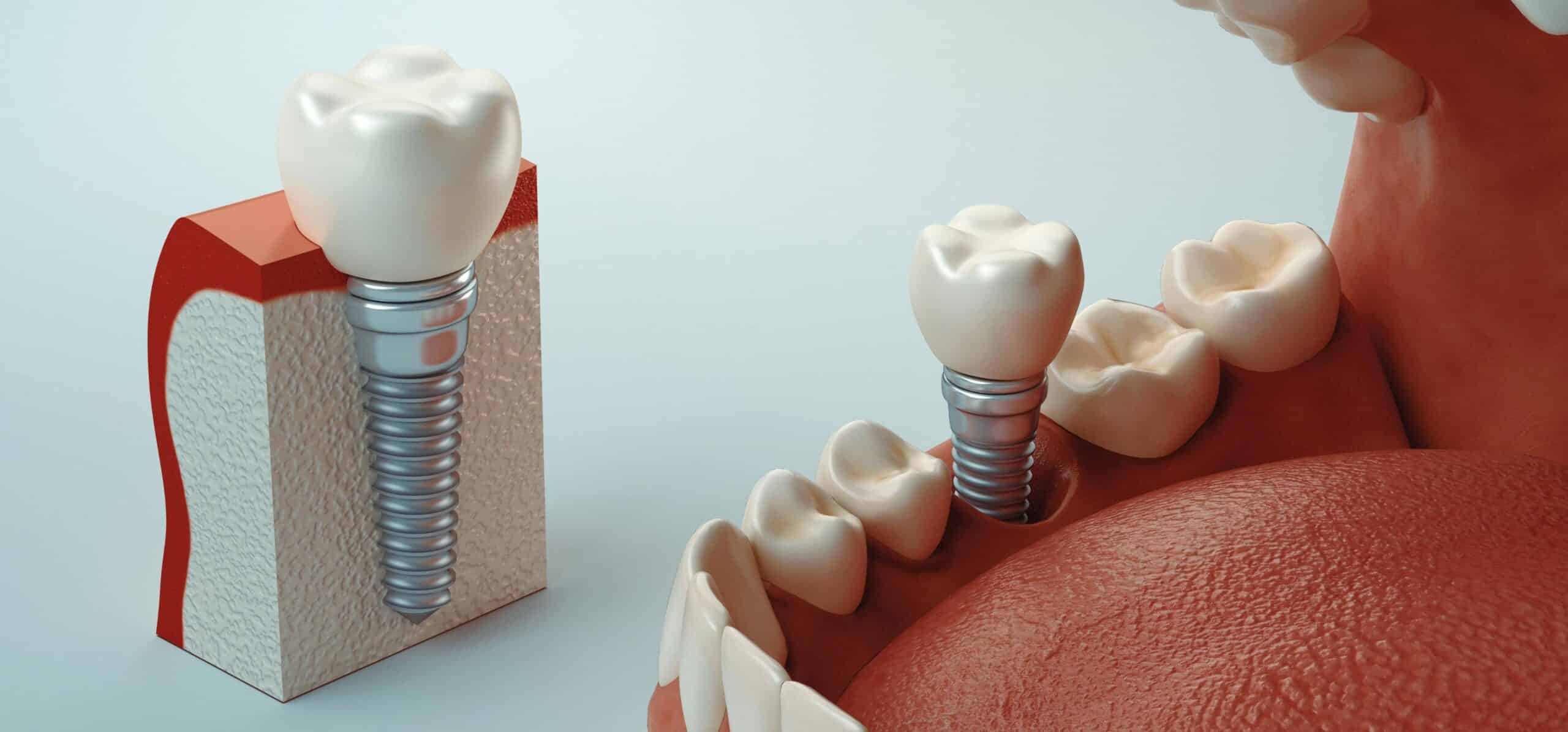 implants-dentaires-ont-ils-une-duree-de-vie-cover-dr-temstet-scaled